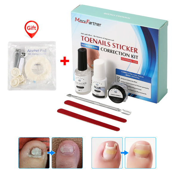 Skymore Ingrown Toenail Correction Tool Nail Repair Kit For Broken Nails Toe Correction Separator