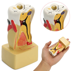 Teaching Dental Disease Teeth Implantation Model Study