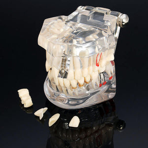 Teaching Dental  Disease Teeth Implantation Model